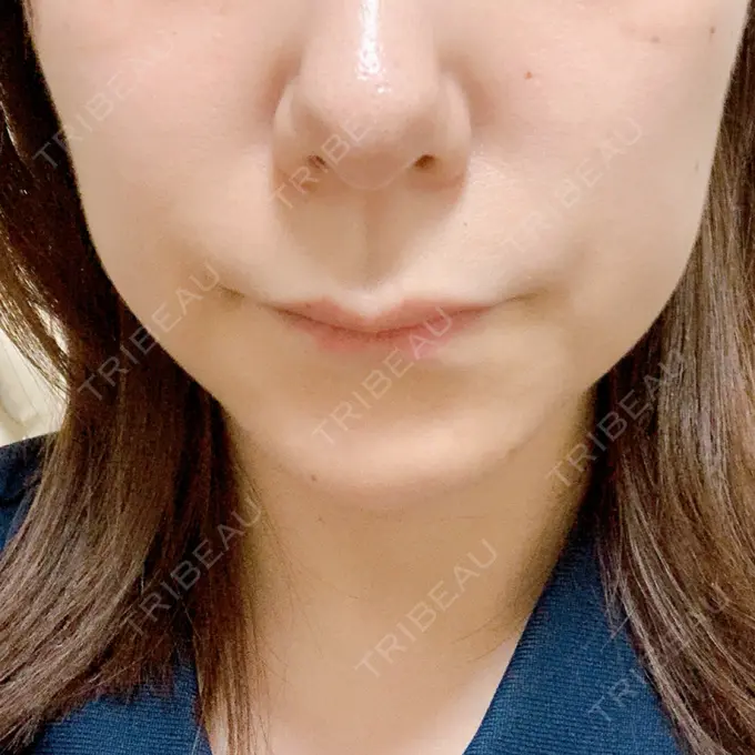 ボトックス（エラ・小顔） / マイクロボトックス / ボトックス（首） / ボトックス（人中） 筋肉・美容クリニック AFTER メイン用