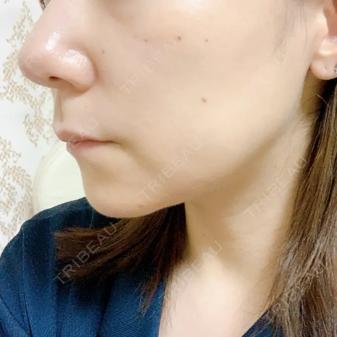 ボトックス（エラ・小顔） / マイクロボトックス / ボトックス（首） / ボトックス（人中） 筋肉・美容クリニック DAY 10 メイン用