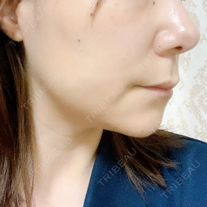 ボトックス（エラ・小顔） / マイクロボトックス / ボトックス（首） / ボトックス（人中） 筋肉・美容クリニック DAY 10 メイン用