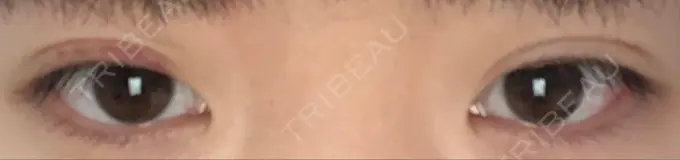 二重埋没 湘南美容クリニック 京都院 DAY 17 メイン用