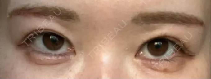 眉下切開 / ボトックス（眉間） / ボトックス（額） 銀座リシェスクリニック DAY 11 メイン用