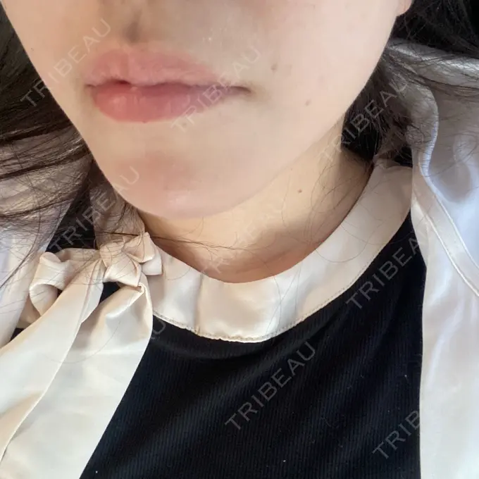 その他（輪郭） ルラ美容クリニック 渋谷本院 DAY 9 メイン用