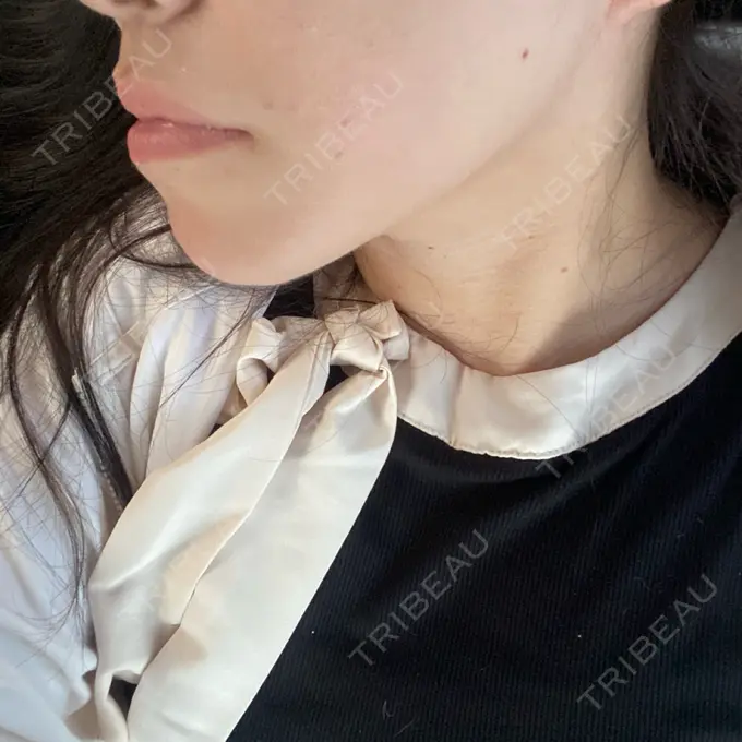 その他（輪郭） ルラ美容クリニック 渋谷本院 DAY 9 メイン用