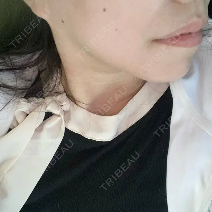 その他（輪郭） ルラ美容クリニック 渋谷本院 DAY 9 メイン用