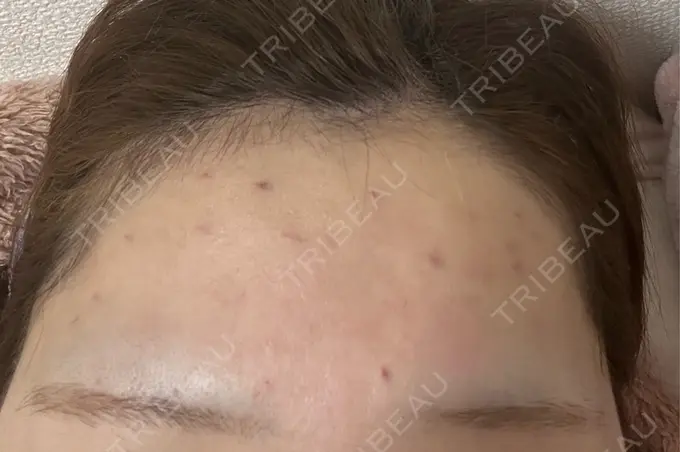 ボトックス（あご） / ボトックス（口角） / ボトックス（眉間） / ボトックス（額） REDLINE CLINIC DAY 0 メイン用