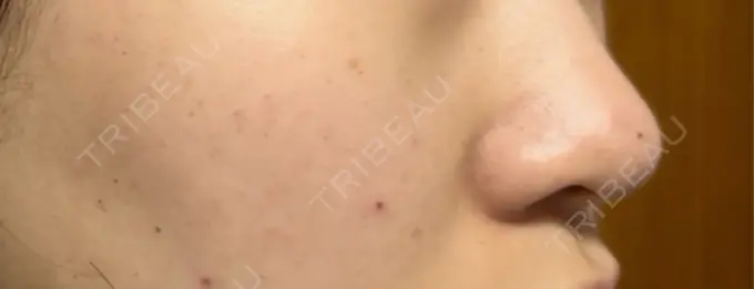 ルメッカ Grias clinic （ジリアスクリニック） DAY 0 メイン用