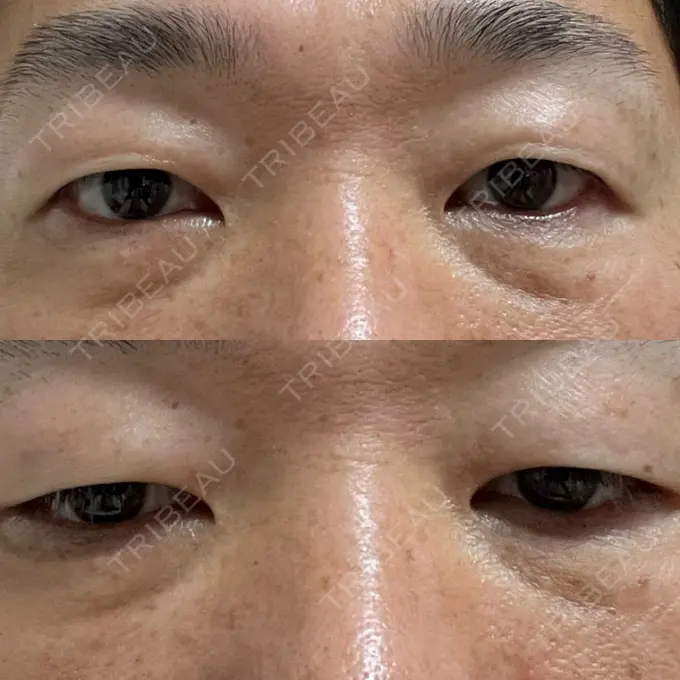 クマ治療 / 下まぶたの脂肪取り ROOTS Clinic DAY 5 メイン用