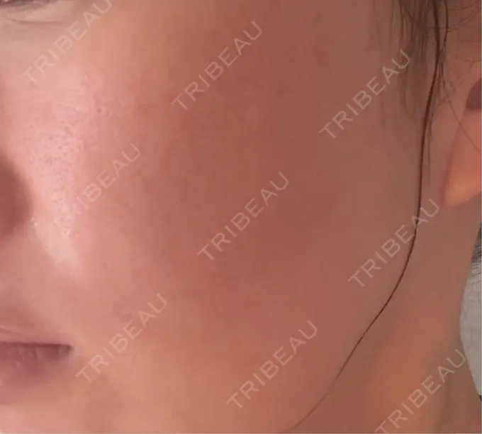 肌育注射（ジュベルックなど） / その他（肌） ゆきスキンクリニック 東池袋 DAY 4 メイン用