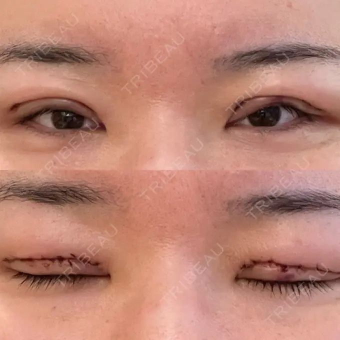 眼瞼下垂（切開） 博多もへじのクリニック DAY 2 メイン用