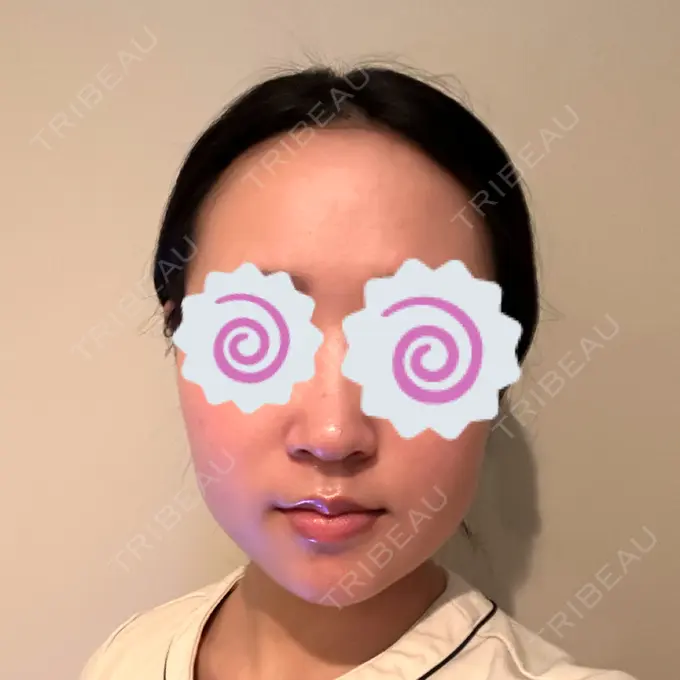 脂肪吸引（顔） / ボトックス（エラ・小顔） Mods Clinic（モッズクリニック） 名古屋院 AFTER メイン用