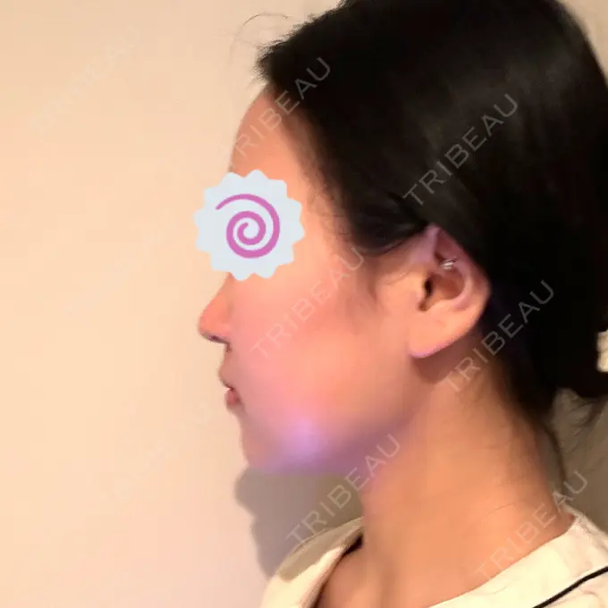 脂肪吸引（顔） / ボトックス（エラ・小顔） Mods Clinic（モッズクリニック） 名古屋院 DAY 178 メイン用