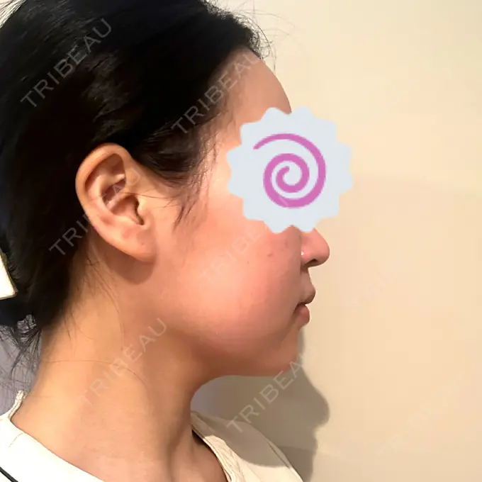 脂肪吸引（顔） / ボトックス（エラ・小顔） Mods Clinic（モッズクリニック） 名古屋院 DAY 178 メイン用