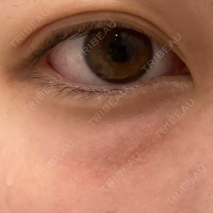 美肌レーザー まゆりなclinic 名古屋栄 AFTER メイン用