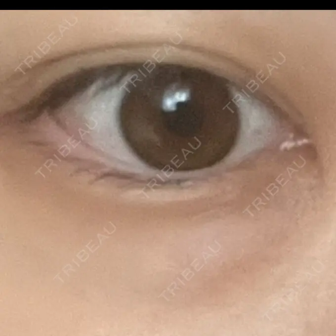 美肌レーザー まゆりなclinic 名古屋栄 DAY 11 メイン用