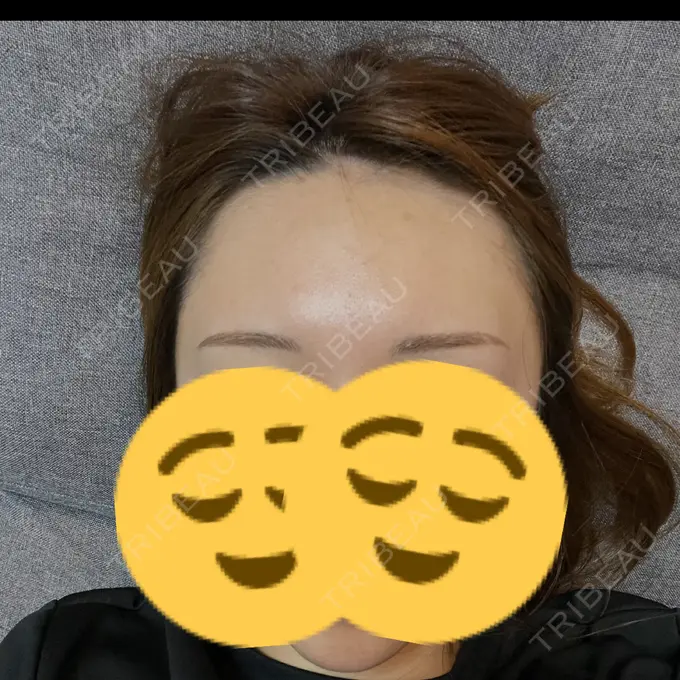 ヒアルロン酸注入（額） アモーレクリニック 名古屋院 DAY 8 メイン用