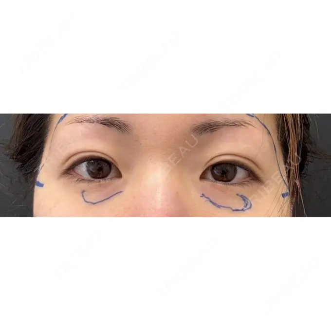 二重埋没 / 自然癒着法 ルラ美容クリニック 福岡本院 DAY 35 メイン用