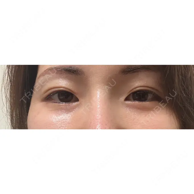 二重埋没 / 自然癒着法 ルラ美容クリニック 福岡本院 AFTER メイン用