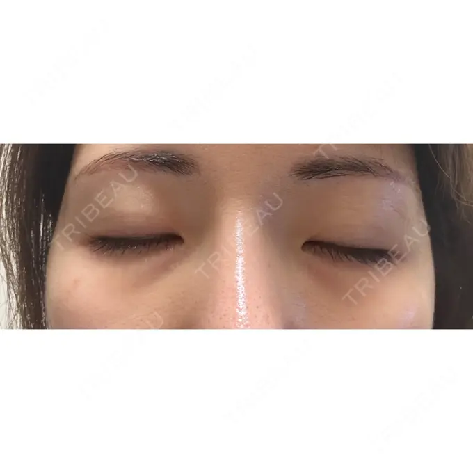 二重埋没 / 自然癒着法 ルラ美容クリニック 福岡本院 DAY 129 メイン用