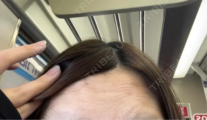 ボトックス（あご） / ボトックス（口角） / ボトックス（眉間） / ボトックス（額） REDLINE CLINIC DAY 2 メイン用