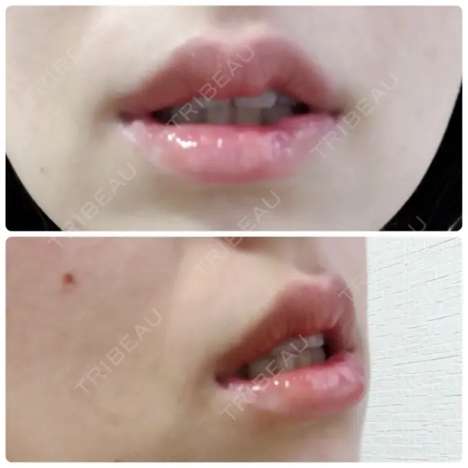 口唇縮小術 品川スキンクリニック表参道院 DAY 17 メイン用