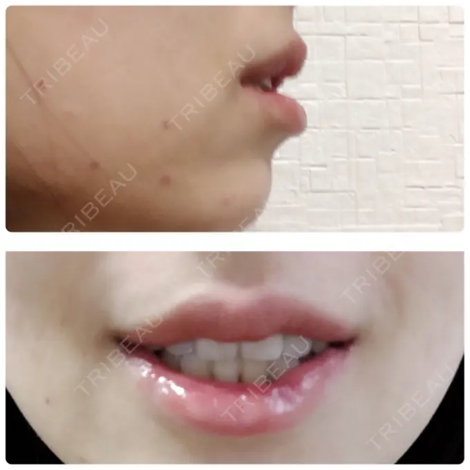 口唇縮小術 品川スキンクリニック表参道院 DAY 17 メイン用