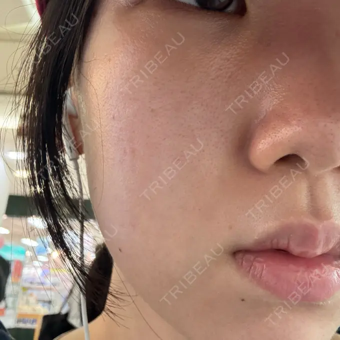 ピーリング（ニキビ・毛穴） / ピコフラクショナルレーザー（毛穴・ニキビ跡） 名駅なぎクリニック AFTER メイン用