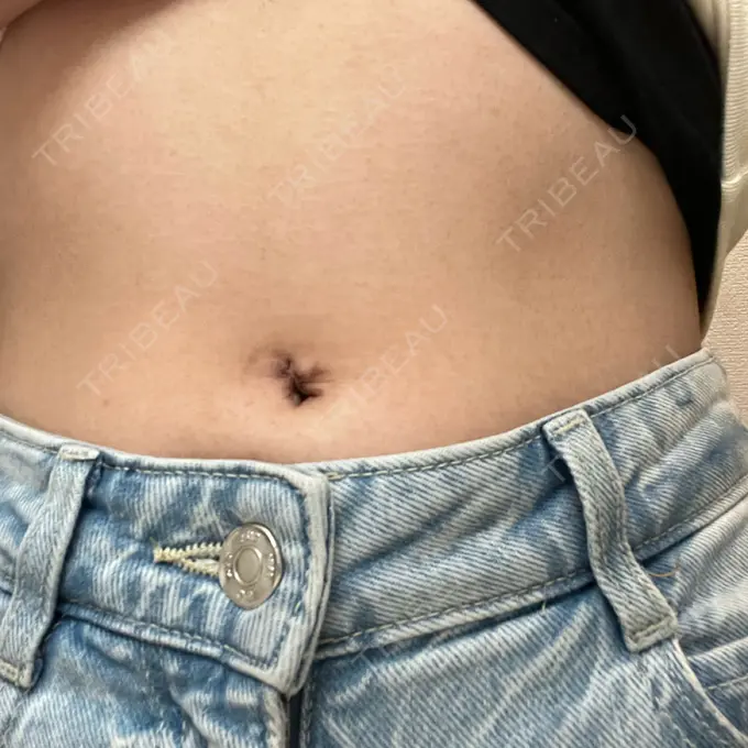 へそ形成 藤・ナチュレ美容クリニック 銀座院 AFTER メイン用