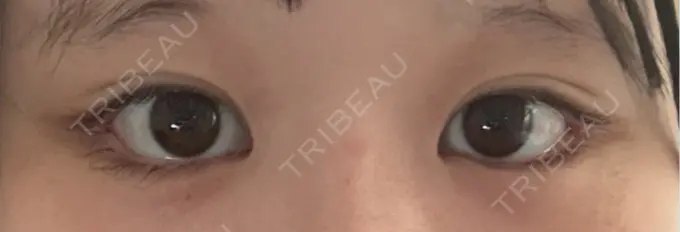 目尻切開 / タレ目形成・グラマラスライン（埋没） LOUIS CLINIC 二子玉川院【ルイクリニック】 DAY 7 メイン用