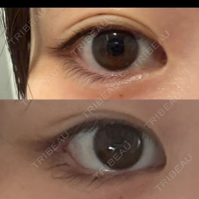 目尻切開 / タレ目形成・グラマラスライン（埋没） LOUIS CLINIC 二子玉川院【ルイクリニック】 DAY 6 メイン用