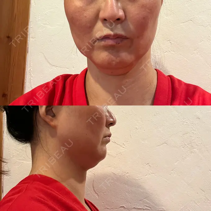 脂肪溶解注射（顔） 湘南美容クリニック 藤沢院 DAY 0 メイン用