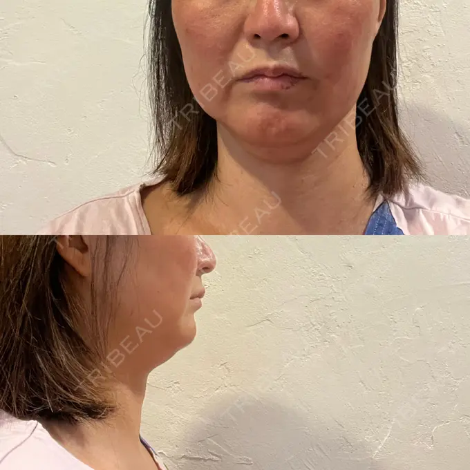 脂肪溶解注射（顔） 湘南美容クリニック 藤沢院 DAY 1 メイン用