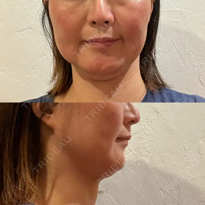 脂肪溶解注射（顔） 湘南美容クリニック 藤沢院 DAY 6 メイン用