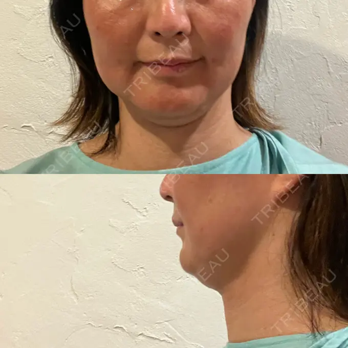 脂肪溶解注射（顔） 湘南美容クリニック 藤沢院 DAY 11 メイン用