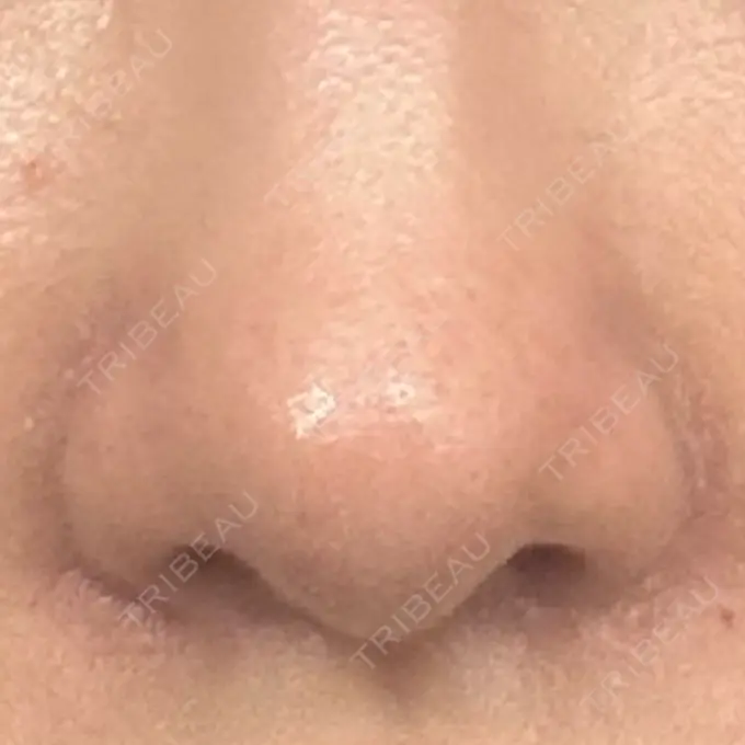 鼻孔縁挙上 シエルクリニック DAY 55 メイン用