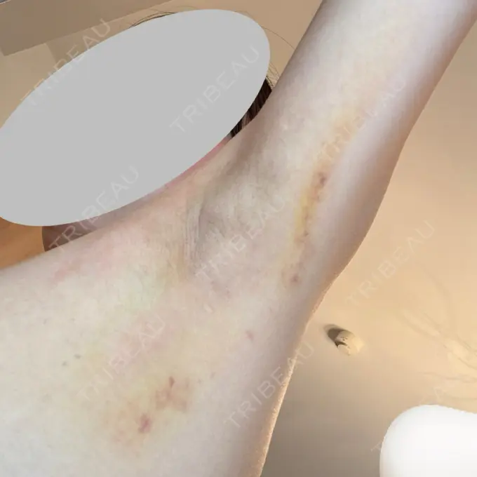 ワキ汗治療（レーザー） Fellez Clinic【フェルズクリニック】 DAY 5 メイン用