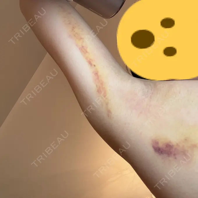 ワキ汗治療（レーザー） Fellez Clinic【フェルズクリニック】 DAY 5 メイン用