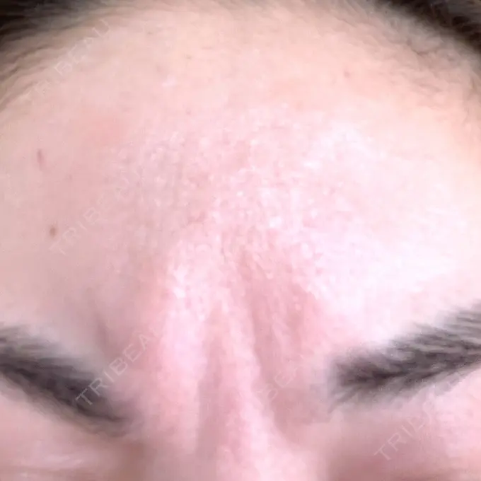 ボトックス（あご） / マイクロボトックス / ボトックス（眉間） / ボトックス（首） / ボトックス（ガミースマイル） M'sクリニック【エムズクリニック】 DAY 2 メイン用