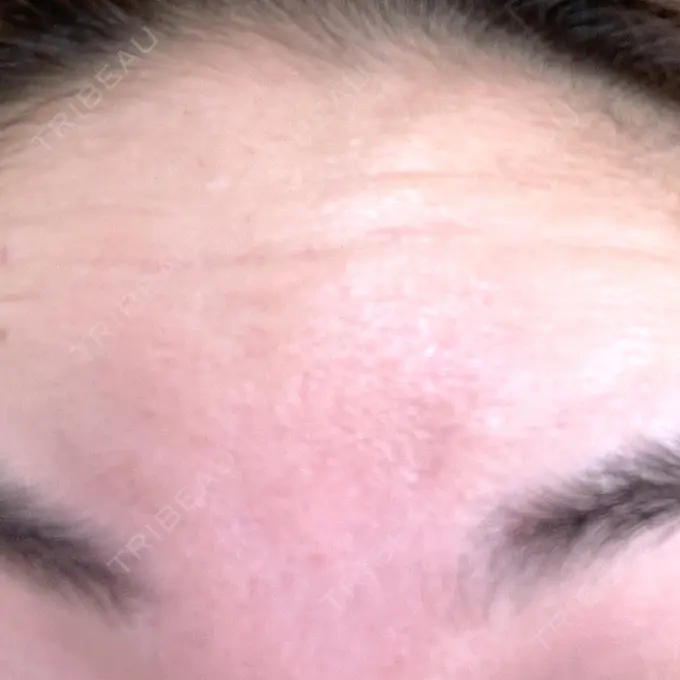 ボトックス（あご） / マイクロボトックス / ボトックス（眉間） / ボトックス（首） / ボトックス（ガミースマイル） M'sクリニック【エムズクリニック】 DAY 2 メイン用