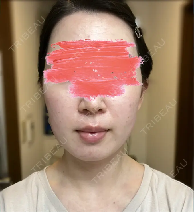 ボトックス（エラ・小顔） / 脂肪溶解注射（顔） SUNMELIA SKIN CLINIC AFTER メイン用