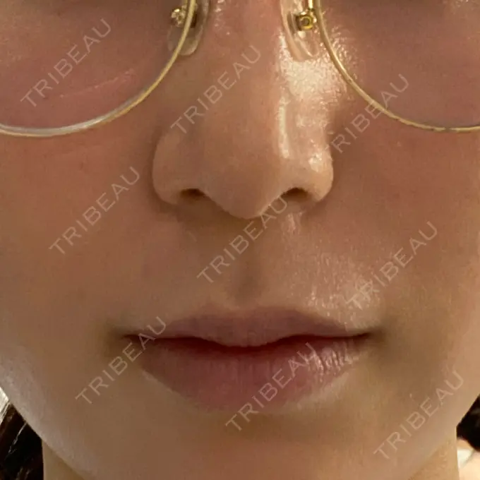 レーザートーニング（美白・肝斑） MAクリニック 心斎橋 DAY 0 メイン用