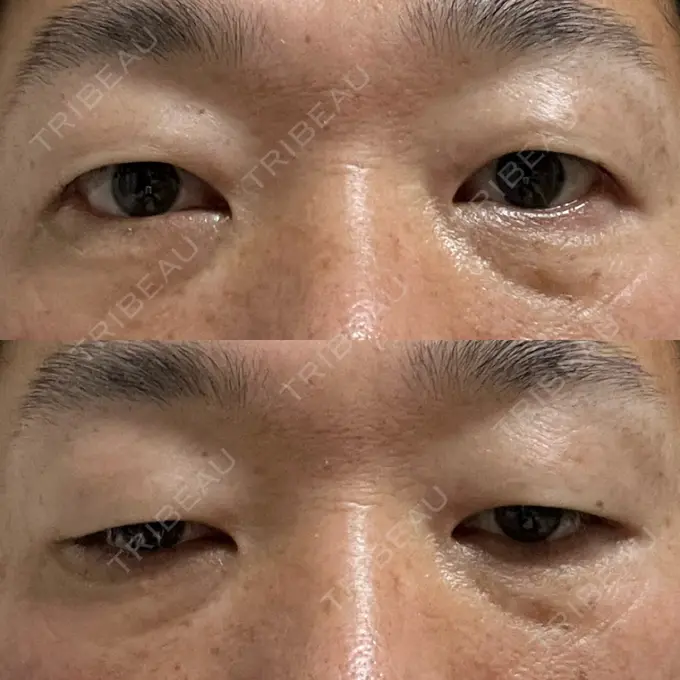 クマ治療 / 下まぶたの脂肪取り ROOTS Clinic DAY 8 メイン用