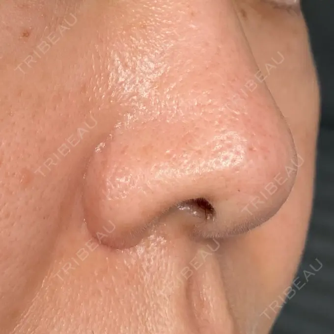 サブシジョン / 肌育注射（ジュベルックなど） / その他（肌） ゆきスキンクリニック 東池袋 DAY 9 メイン用