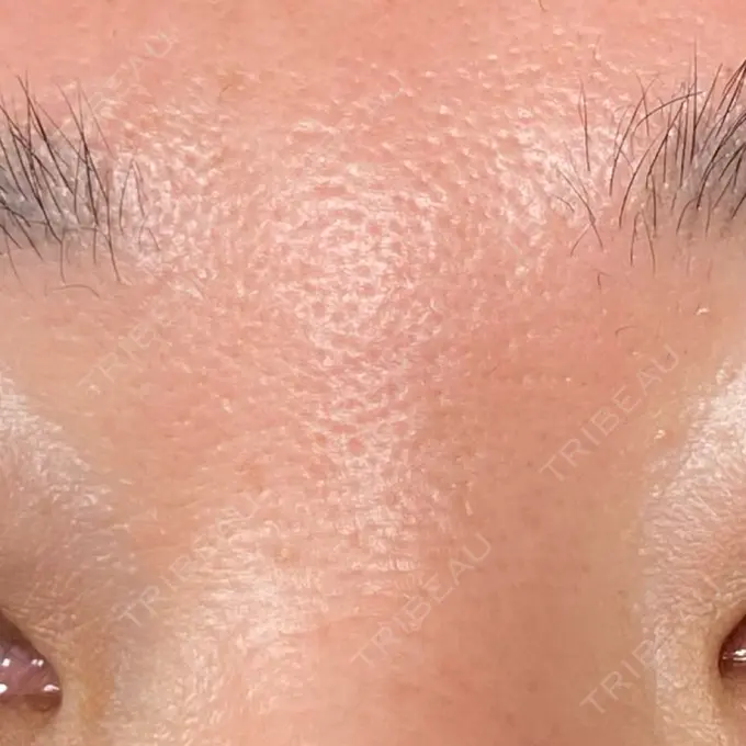 サブシジョン / 肌育注射（ジュベルックなど） / その他（肌） ゆきスキンクリニック 東池袋 DAY 9 メイン用