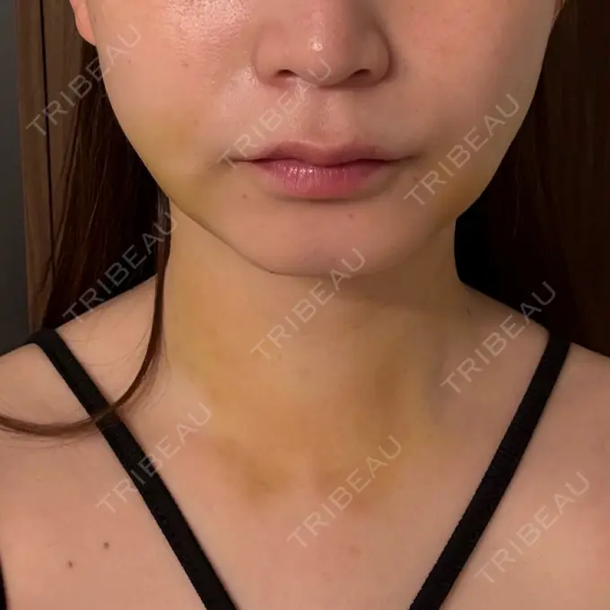 糸リフト / 脂肪吸引（顔） / 脂肪吸引（二の腕） / 脂肪吸引（脚） / 脂肪吸引（お腹） / 脂肪吸引（お尻） / 脂肪吸引（腰） / 脂肪吸引（背中） / 脂肪吸引（肩） ヴェルトラクリニック 新宿院 DAY 7 メイン用