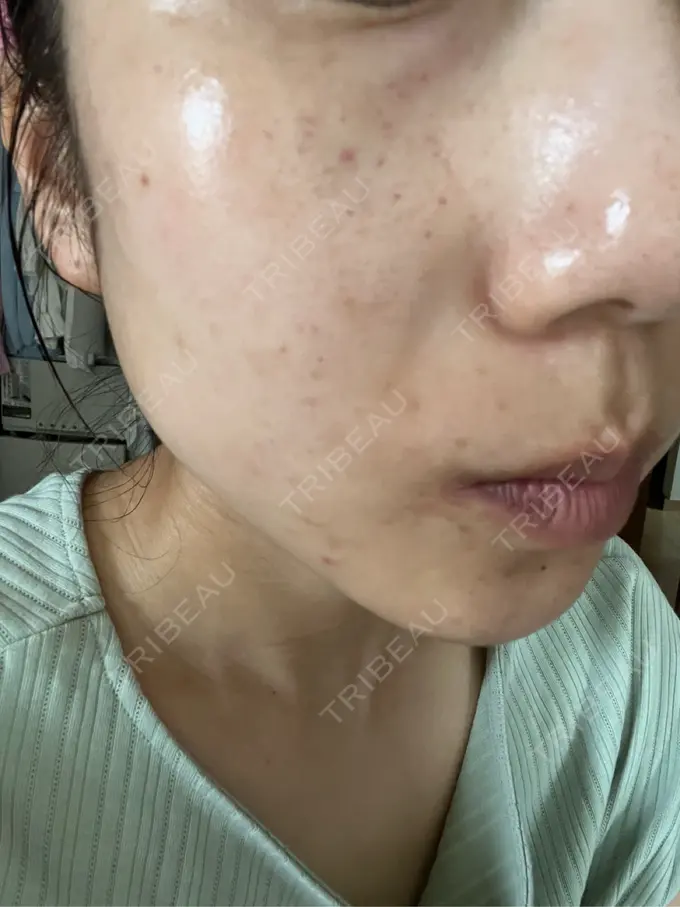 水光注射（ハリ・美肌） しんゆり美容健康クリニック DAY 2 メイン用