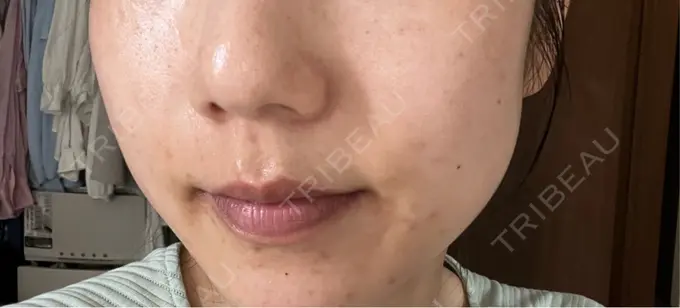 水光注射（ハリ・美肌） しんゆり美容健康クリニック DAY 2 メイン用