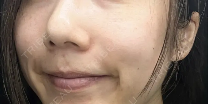 水光注射（ハリ・美肌） しんゆり美容健康クリニック DAY 4 メイン用