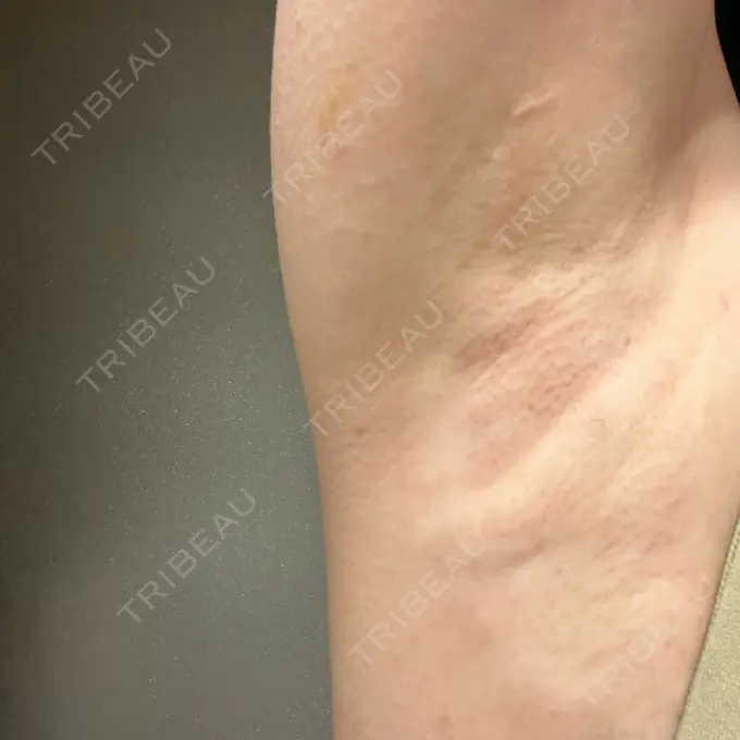 ワキ汗治療（レーザー） ルラ美容クリニック 渋谷本院 DAY 0 メイン用