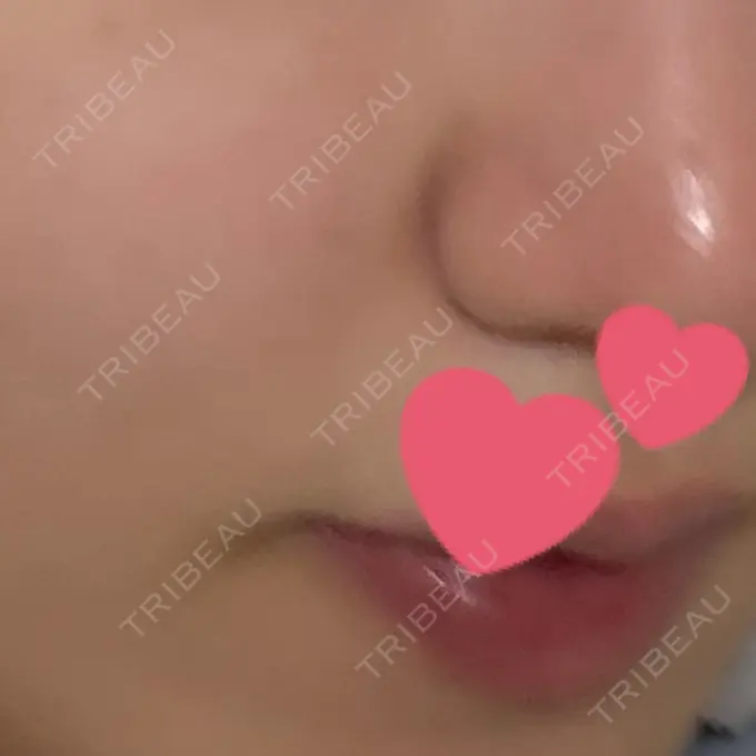 ピコレーザートーニング（美白・肝斑） / 医療脱毛（顔） おおかみ美容のクリニック 横浜院 AFTER メイン用