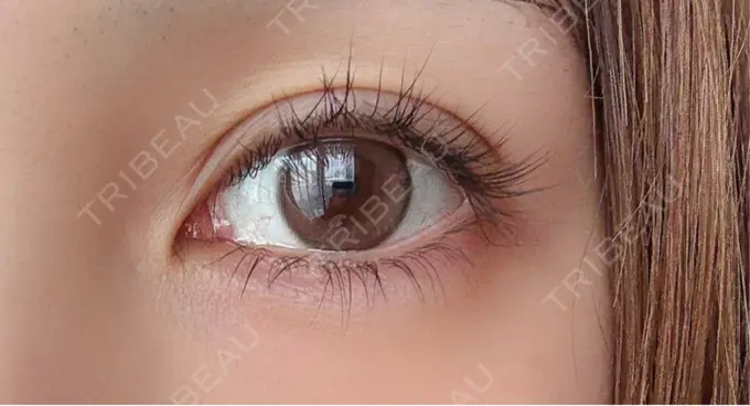 二重埋没 アリエル美容クリニック 横浜院 DAY 14 メイン用